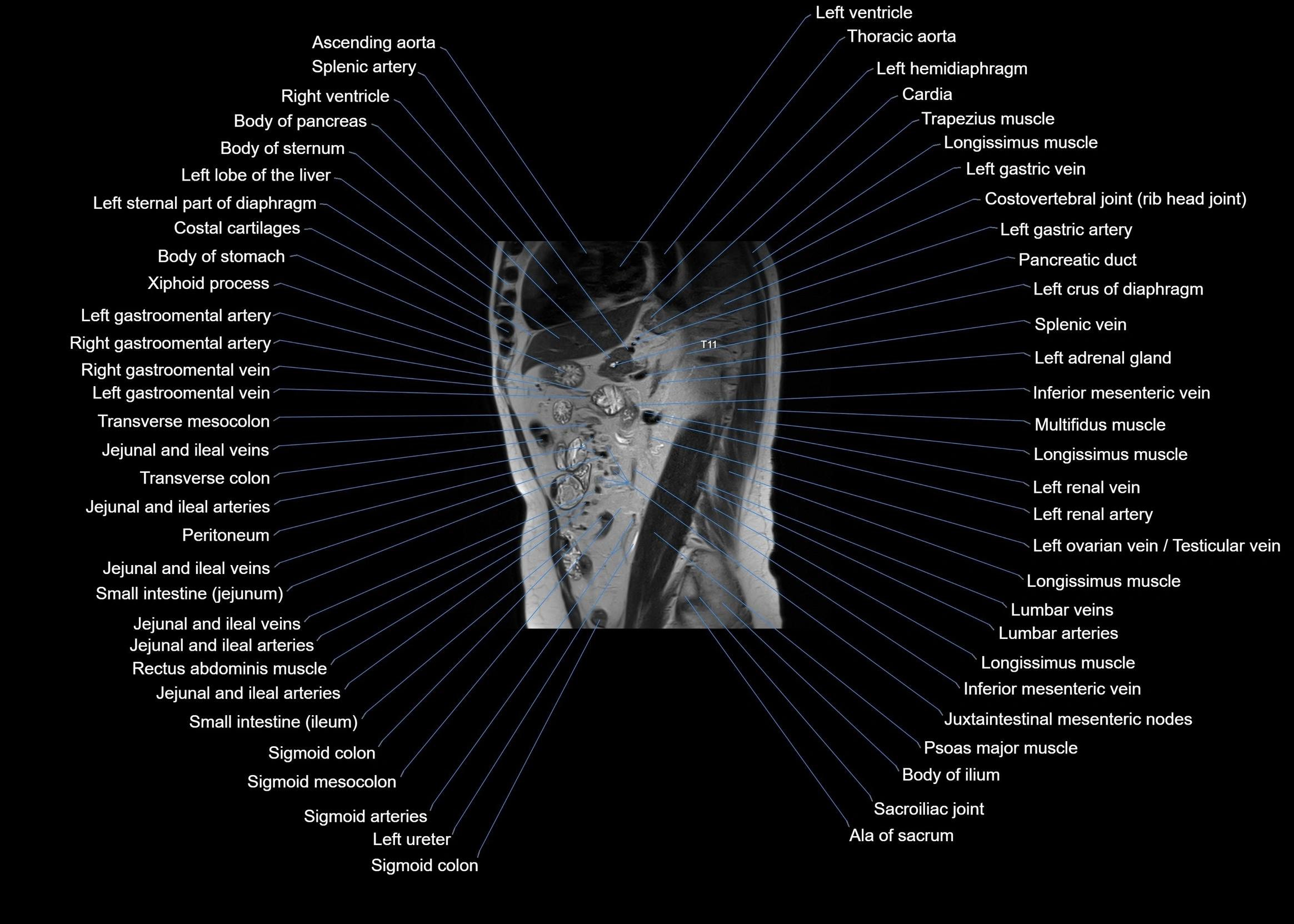 MRI abdomen sagittal cross sectional anatomy  radiology  image-img-00001-00043.webp